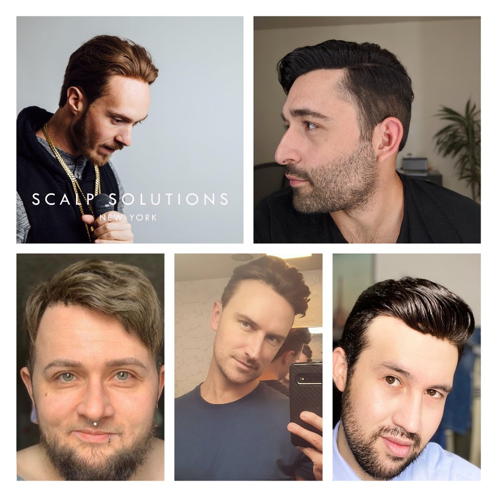 Things You Need to Know About Men's Non Surgical Hair Replacement