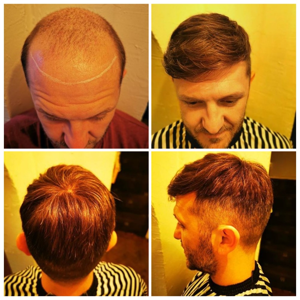 What Can We Do to Deal with Hair Thinning Crown?