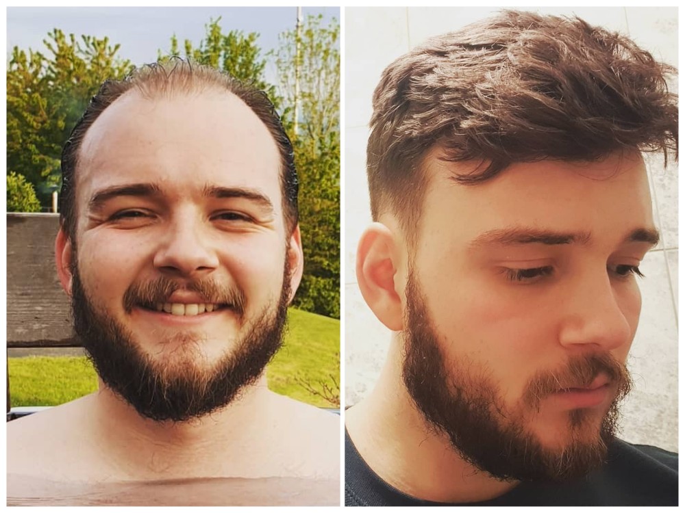 sistema de cabello antes y después de 