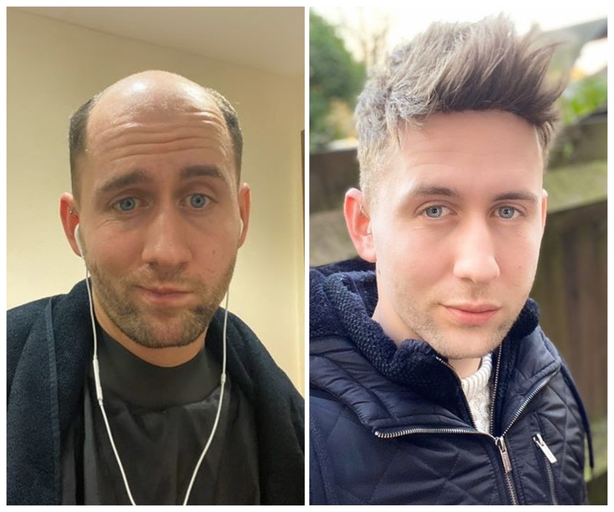 sistema de cabello lavivid antes y después de