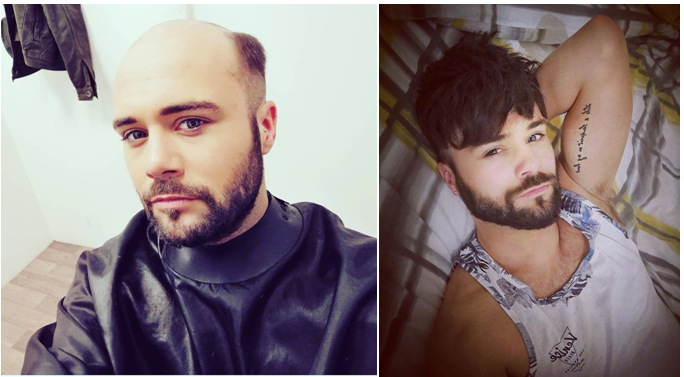 sistema de cabello antes y después de