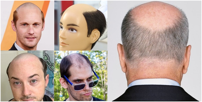 male pattern baldness
