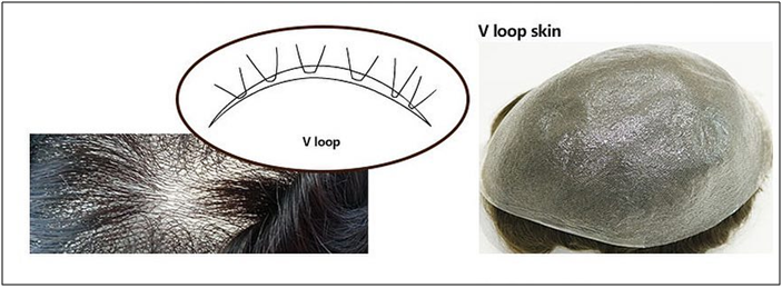 línea de cabello con lazo en V