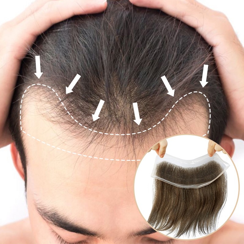 Best Hair patch Attachment in Delhi,India. Starting only  Rs.6000/-.Permanent & Natural In Just 30 mins Get New look With Full Hair,  completely Natural... | By Xpressions Hair Clinic | Facebook