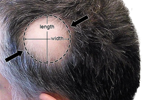 Side/Back Hair Patches