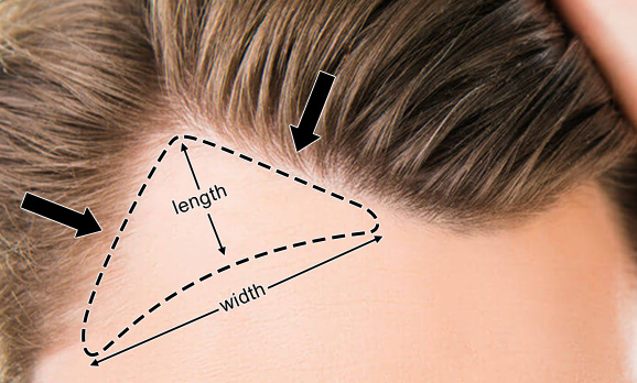 Hair Patch Vs Hair Transplant: Is Hair Patch good option than Transplant